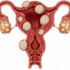 Fibroids tumor