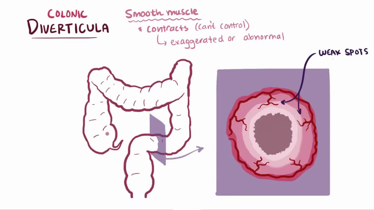 diverticulitis