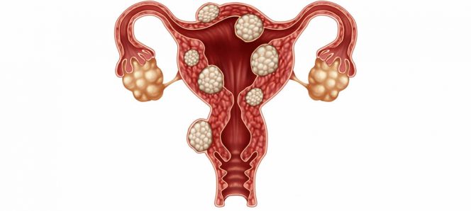 Fibroids tumor