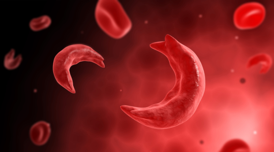 sickle cell