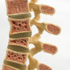 What Is Osteoporosis? (A Comprehensive Scientific and Holistic View) osteoporosis spine