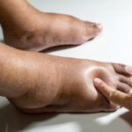What is Edema